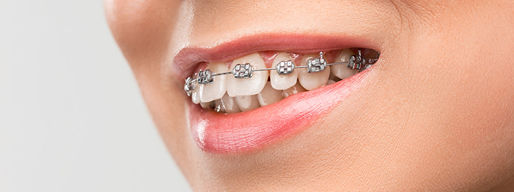 Ortodonti Hakkında Bilinmesi Gerekenler