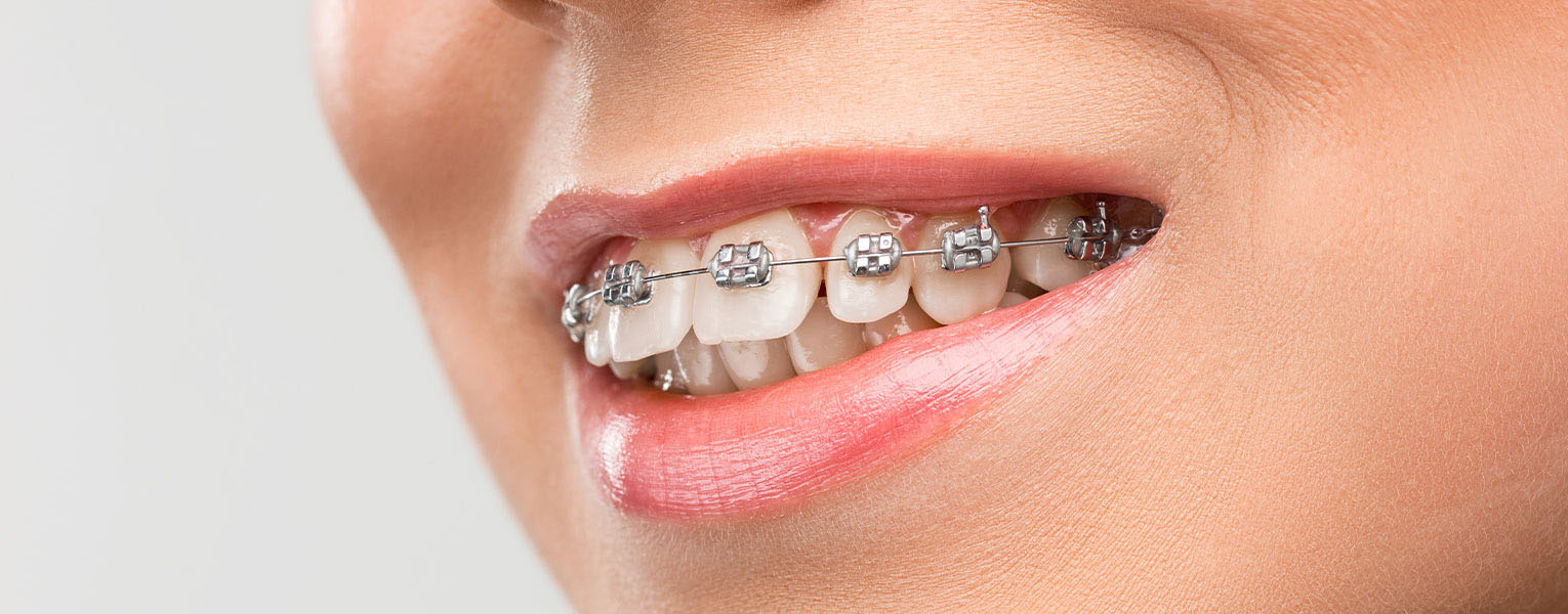 Orthodontic Treatments