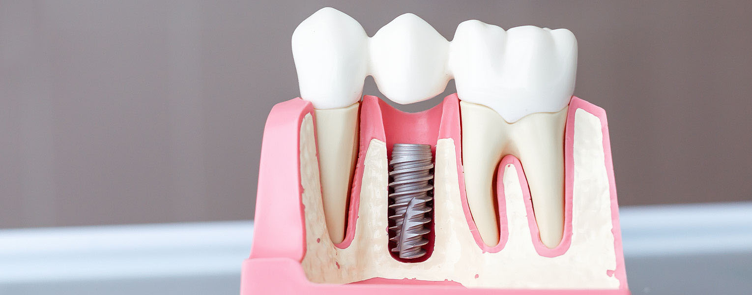 Mini Dental Implants