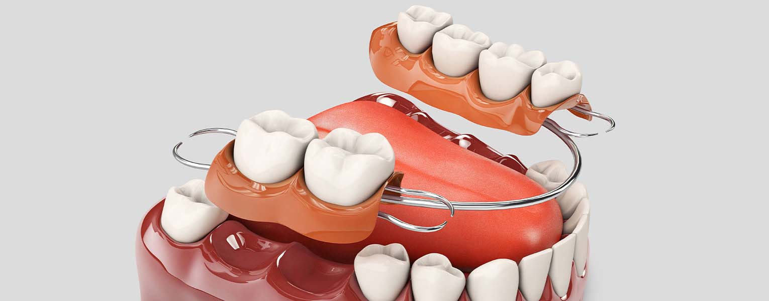 Removable Partial Dentures