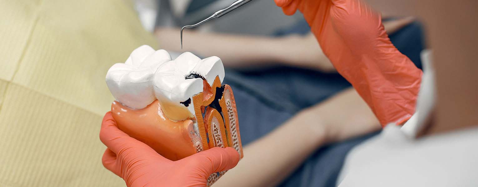 Root Canal Treatment