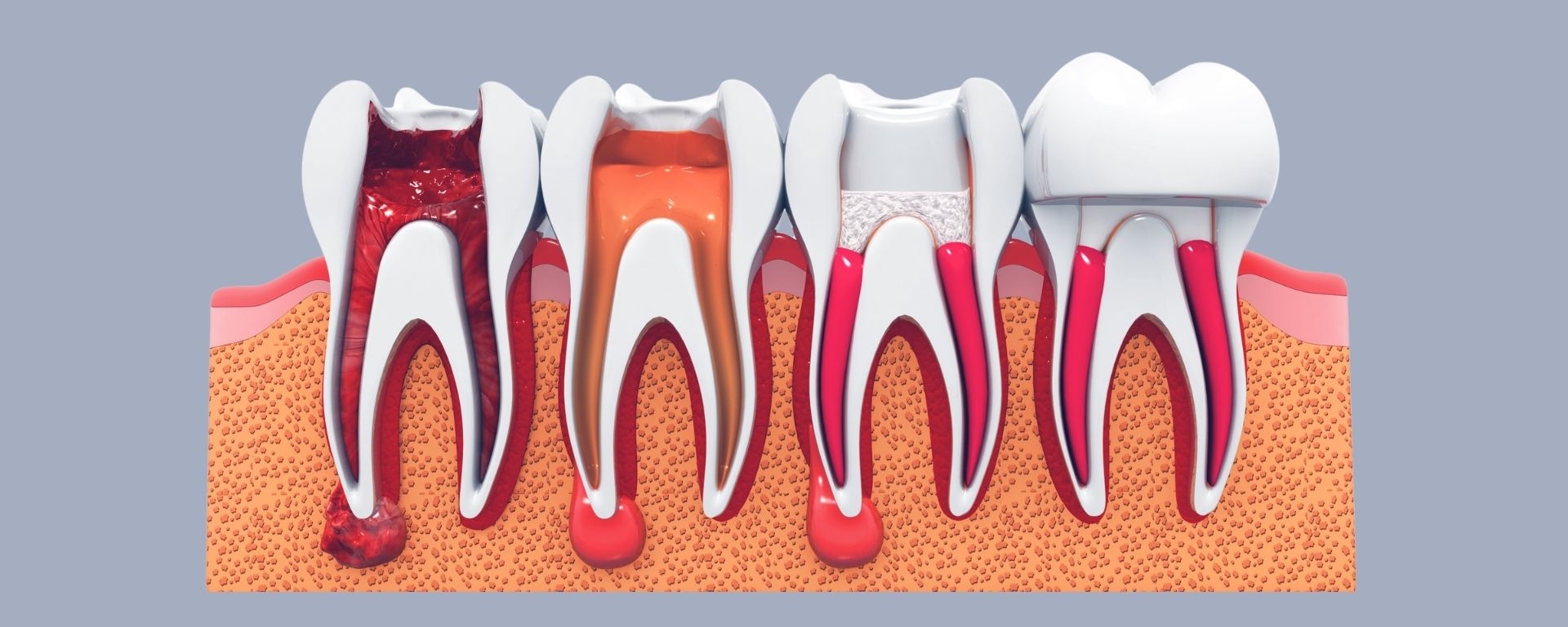 How Long Does a Root Canal Treated Tooth Last?